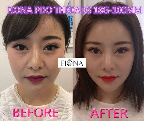 Fiona PDO e hilo de PCL, hilo del lifting facial PDO de 38m m