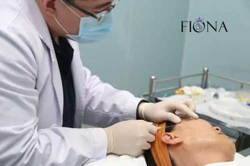 cánula No-quirúrgica del lifting facial 360 4D 6D 12D W del hilo del diente de la elevación de cara PDO PCL PLACL